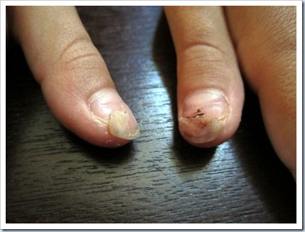 Toddler Fell Off Kitchen Chair Toddler Fell Off Kitchen Chair