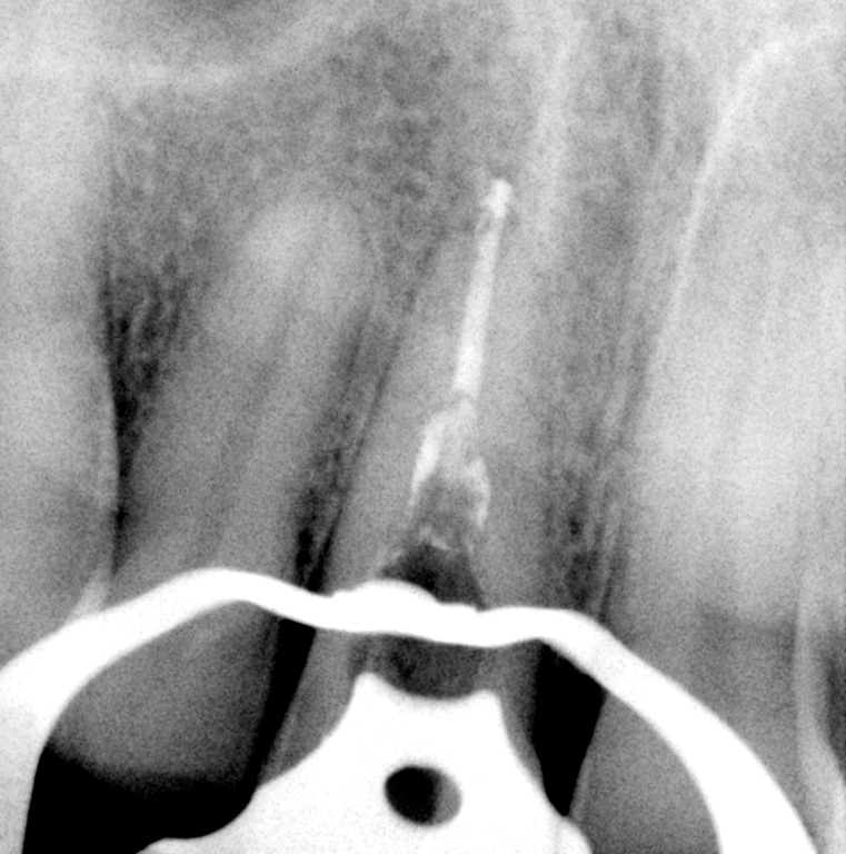 [Internal%2520Resorption%2520SB%2520apical%2520gp010%255B3%255D.jpg]