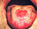sifilis-lengua.jpg
