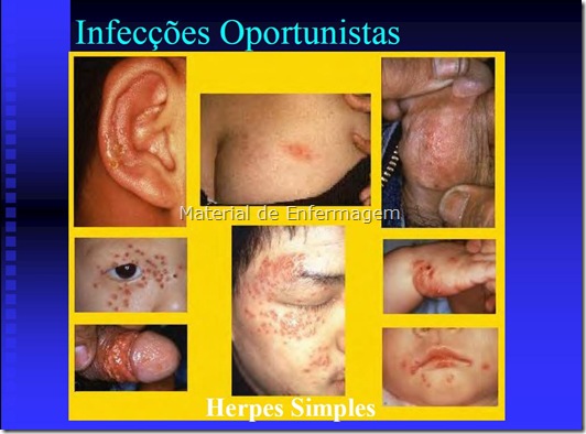 HIV e Adis
