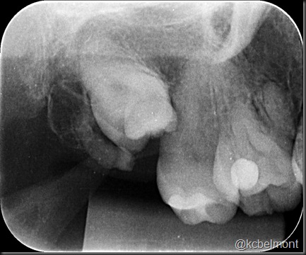 periapical supra 1 periapical supra 1