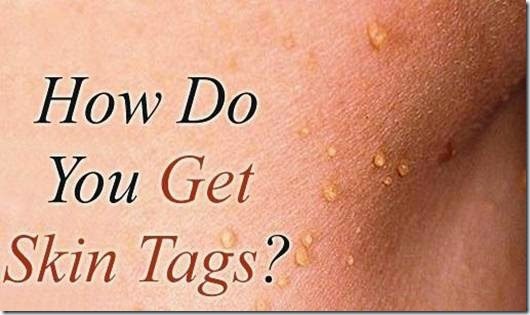 Skin Tag Removal Methods | Beauty and Personal Grooming