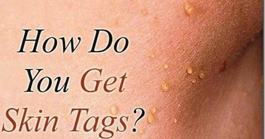 Skin Tag Removal Methods | Beauty and Personal Grooming