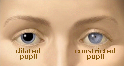 pupille-dilatate-ristrette