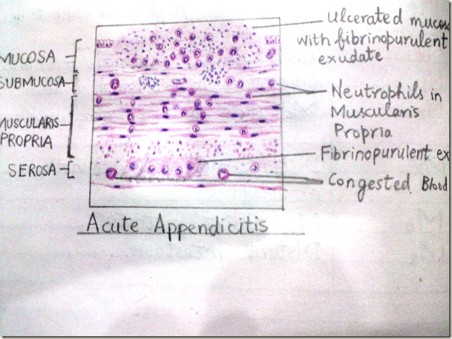 acute appendicitis (2)