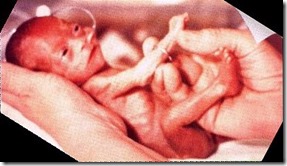 21 Week Old Baby on Delivery 21 Week Old Baby on Delivery
