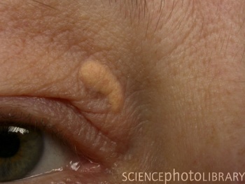 Cholesteatoma+histology