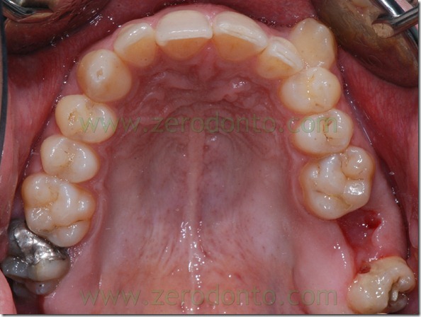 10 estrazione dente