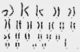 turner syndrome karyotype 