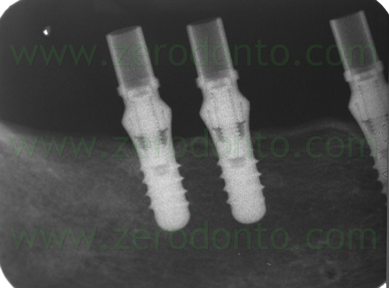 [radiografia-endorale-coping-transfer%255B1%255D.jpg]
