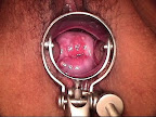vagina-interior-VPH vagina-interior-vph.jpg