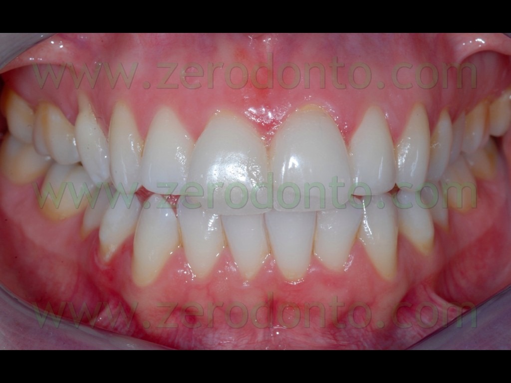 [27-faccette-mock-up-intraorale3.jpg]