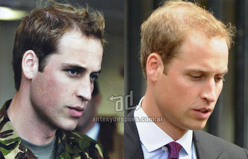 La caida del pelo de Prince William