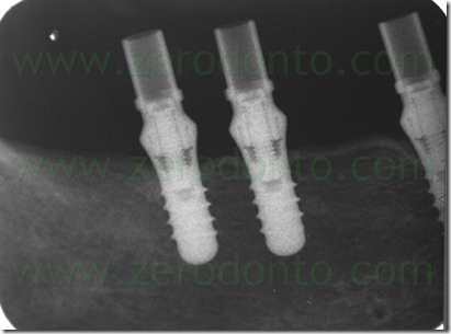 radiografia endorale coping transfer avvitati radiografia endorale coping transfer avvitati