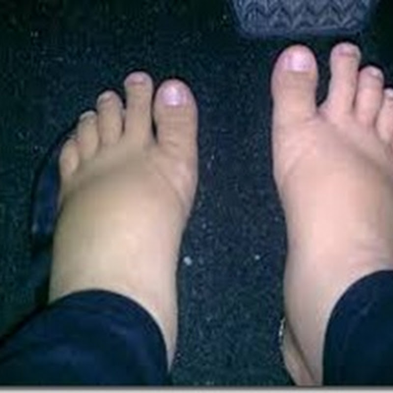 Gejala Kaki Bengkak dan Jenisnya thumbnail