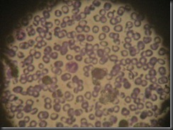 Microcytic anemia high resolution histology slide tsnaps Microcytic anemia high resolution histology slide tsnaps