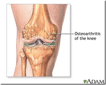 osteoartrose de joelho acupuntura curitiba 2