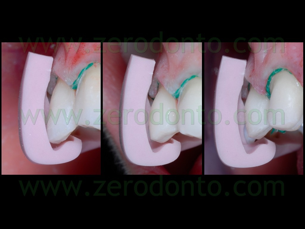 [67-rifinitura-preparazioni-veneers-c%255B1%255D.jpg]