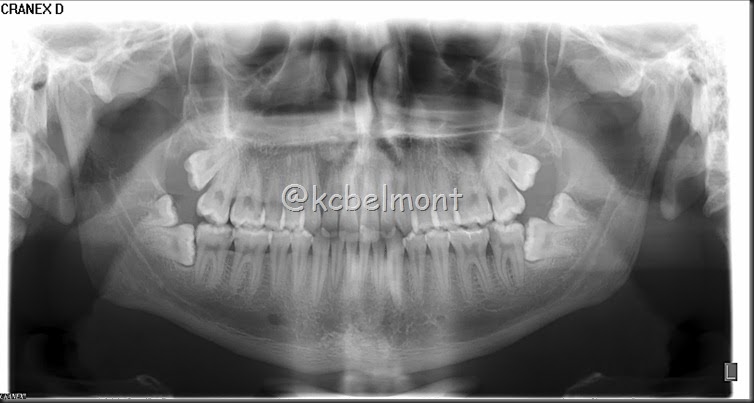 quarto molar inferior quarto molar inferior