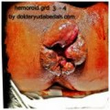 hemoroid1.JPG