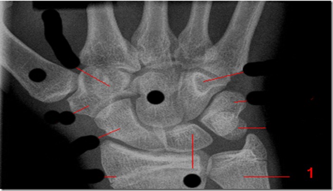 radiografia-polso radiografia-polso