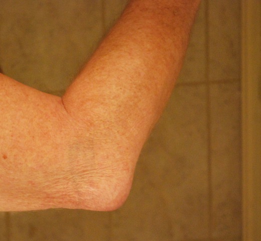 [Student%2520elbow%25201%255B3%255D.jpg]