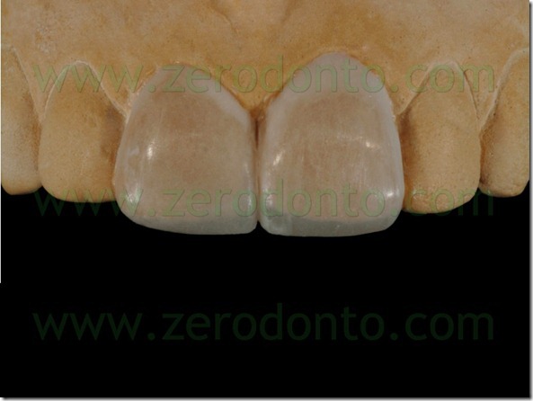 37 faccette wax up additivo