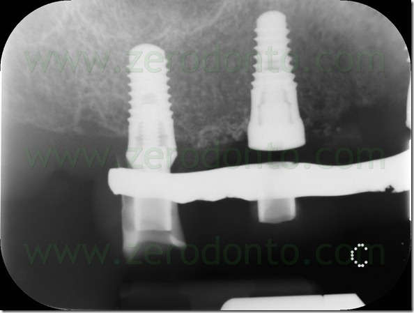 - (247) impianti straumann TE