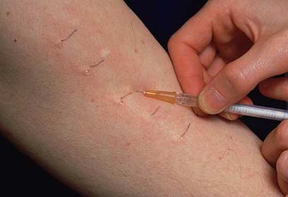 [arm%2520allergy%2520test%255B3%255D.jpg]