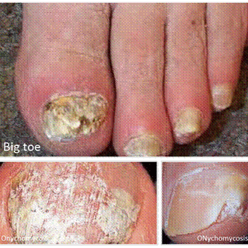 Onychomycosis, Fungal Infection of Fingernail or Toenail | MedicoTips.Com
