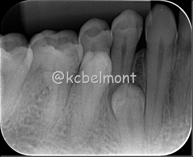 4 pré-molares periapical 4 pré-molares periapical
