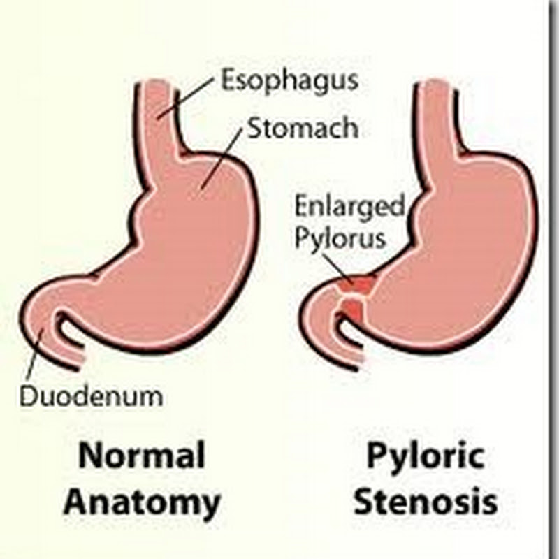 Pyloric Stenosis, Pyloric Obstruction, Stomach Outlet Obstruction