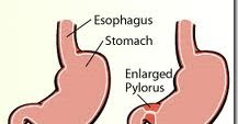 Pyloric Stenosis, Pyloric Obstruction, Stomach Outlet Obstruction 