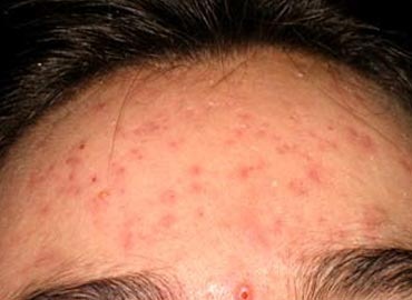 [acne-NTNVa%255B8%255D.jpg]