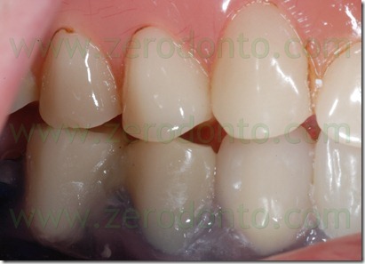 occlusione