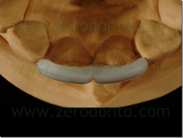 43 faccette overlap palatale