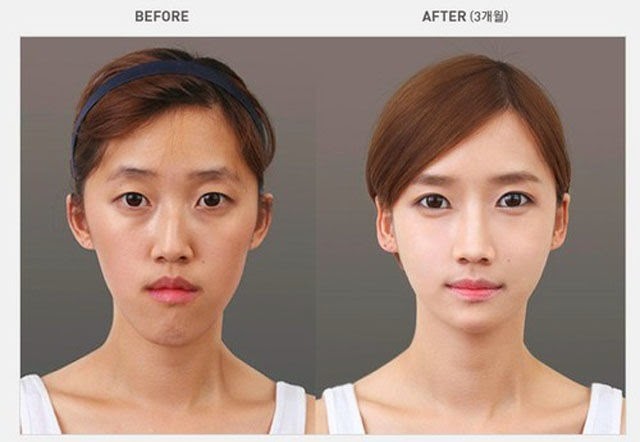 [korean-plastic-surgery-1%255B2%255D.jpg]