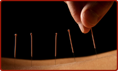 Does Acupuncture Have a Place in Western Medicine