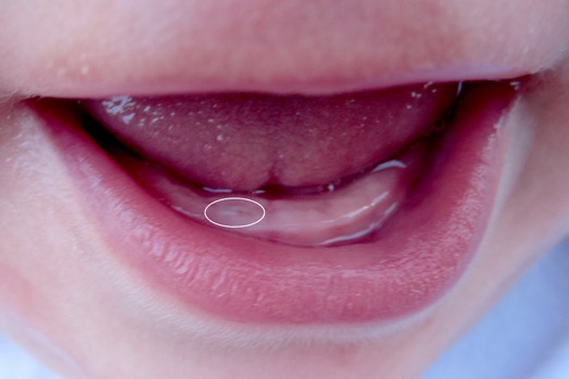[toothcomingoutday2%255B10%255D.jpg]