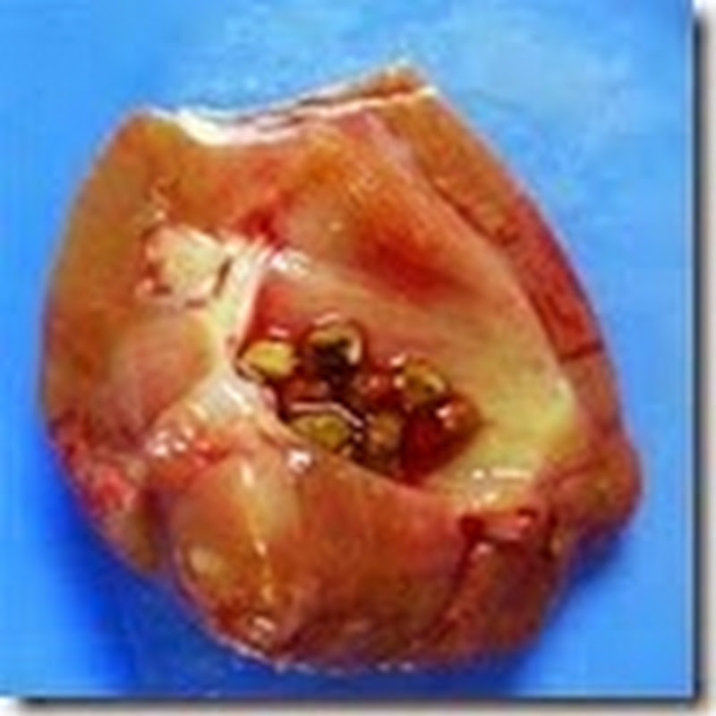 Kelainankelainan dan Penyakitpenyakit pada Sistem Ekskresi