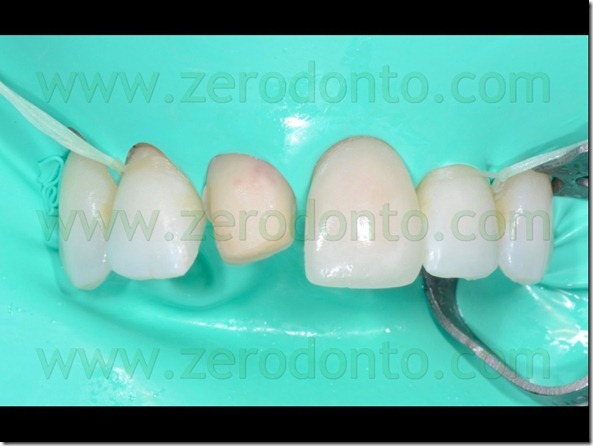 117 isolamento cementazione adesiva veneers