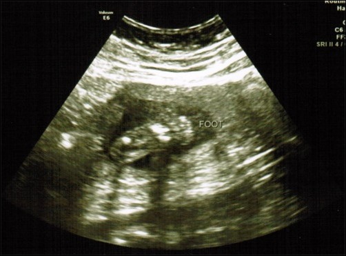 footprint ultrasound