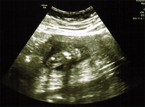 footprint ultrasound footprint ultrasound