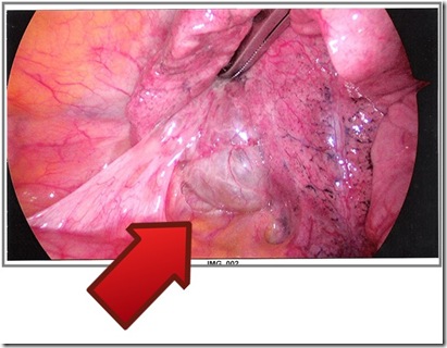 lung infection