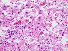 New-Insights-Into-Genetic-Basis-Of-Deadly-Liver-Cancer