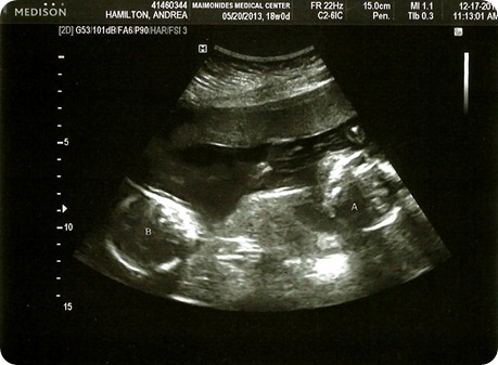 18 Week Ultrasound Both Babies