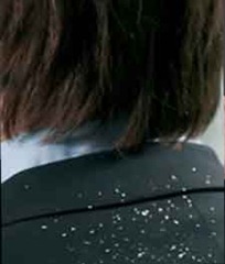 dandruff dandruff