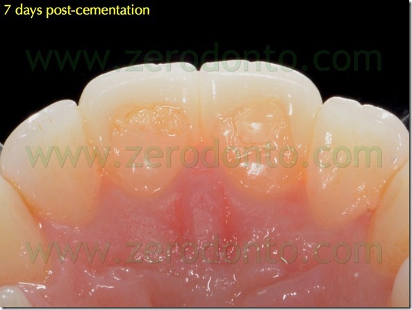 132 tecnica preparazione palatale incisale faccette