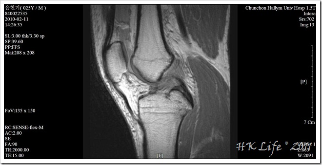 01 knee mri