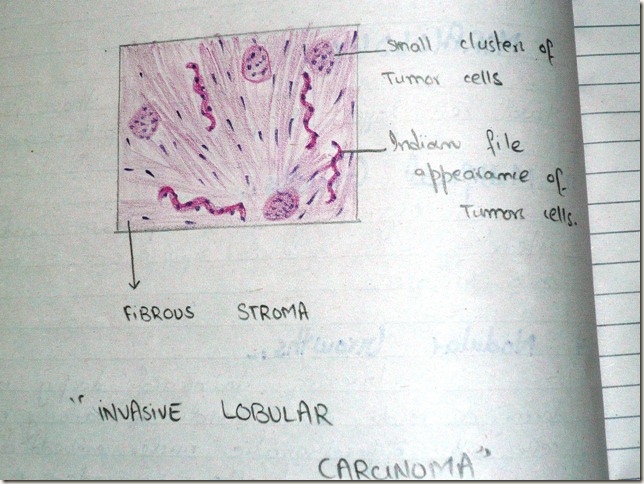 invasive lobular carcinoma diagram histopathology